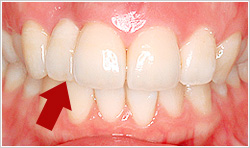 2番目の歯は抜歯し、前歯4本にオールセラミックのかぶせ物を装着した口腔内の写真