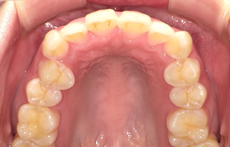 部分矯正の症例写真