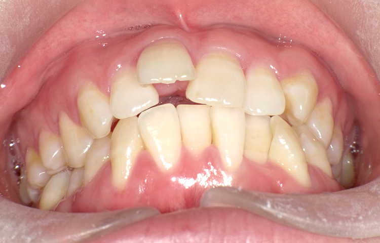 部分矯正の症例写真