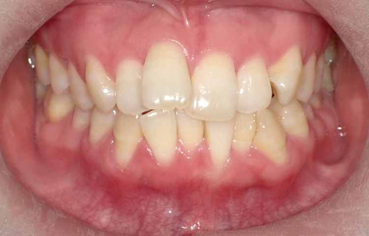 部分矯正の症例写真