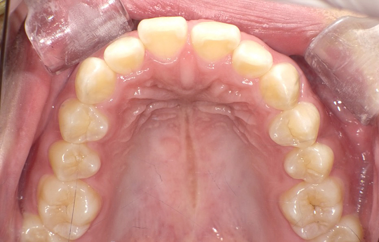 部分矯正の症例写真