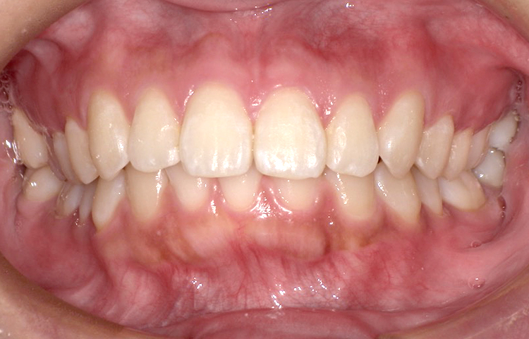 部分矯正の症例写真