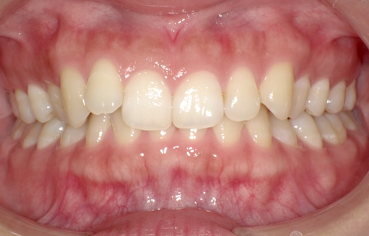 部分矯正の症例写真