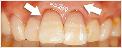 歯茎で歯の根っこが覆われ、見た目が改善された口腔内の写真