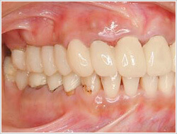 右奥の歯が無くなってしまった部分に仮歯を入れている口腔内の画像