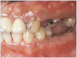 虫歯で左奥の歯も無くなってしまっている口腔内の画像