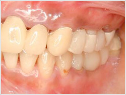 左奥の歯が無くなってしまった部分に仮歯を入れている口腔内の画像