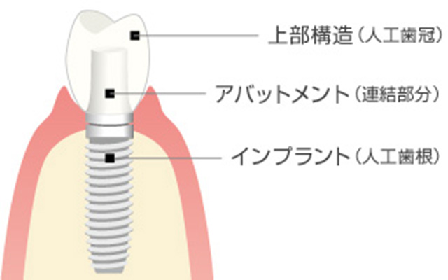 インプラントとは