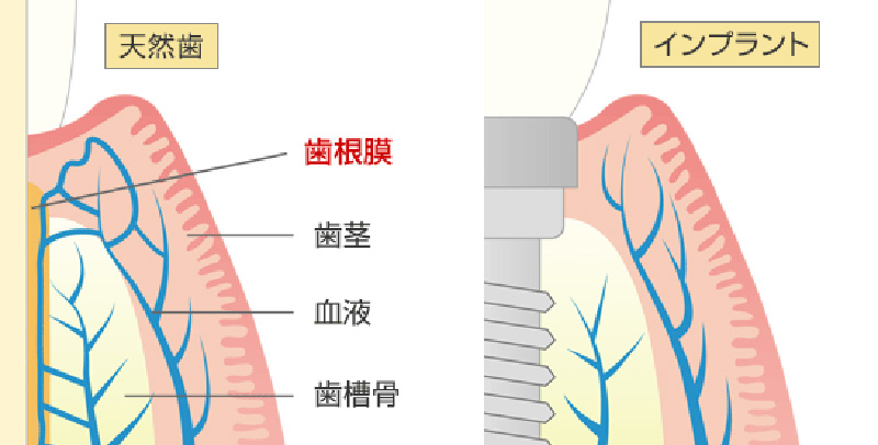 インプラントは天然歯より感染しやすい