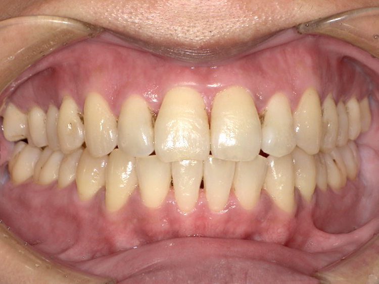 インビザラインの症例