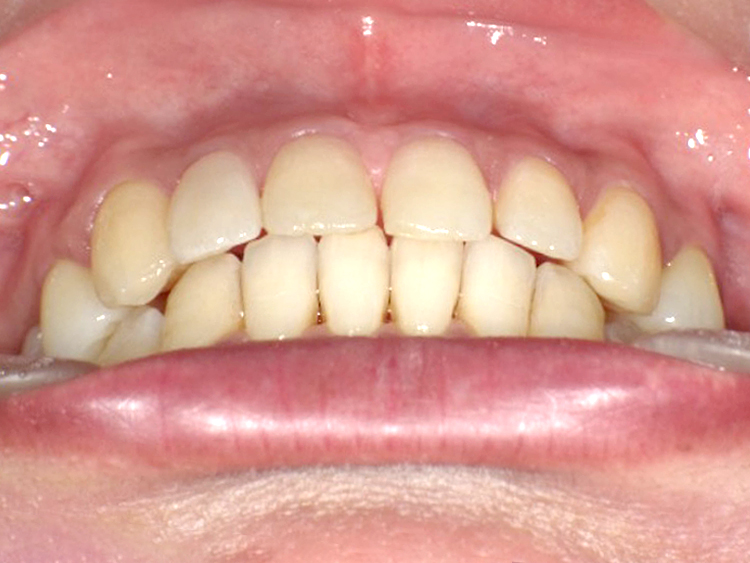 インビザラインの症例