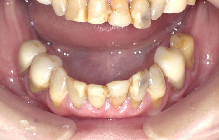 審美歯科の症例